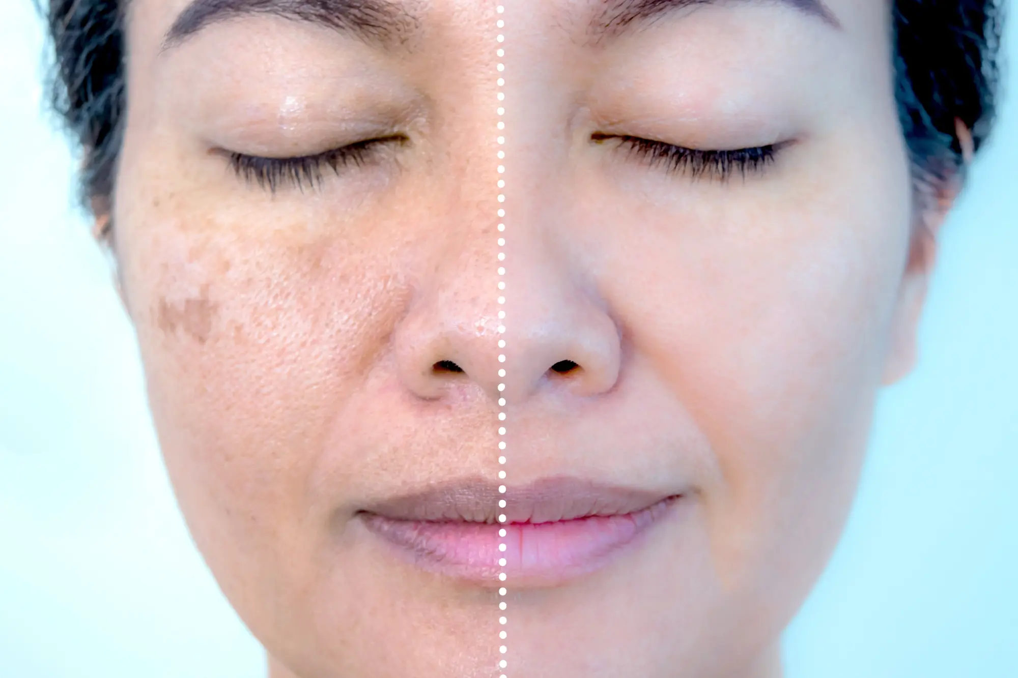 before and after of sun damage treatment